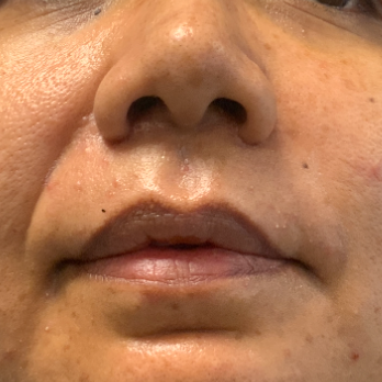 preservation-rhinoplasty-after